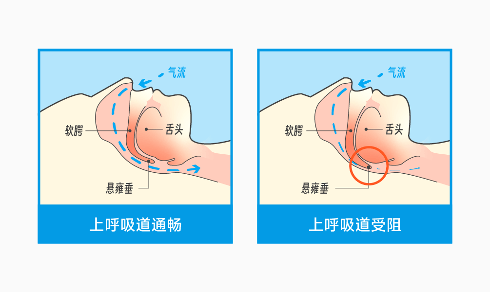 人为什么会打鼾